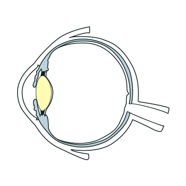 白内障手術イラスト