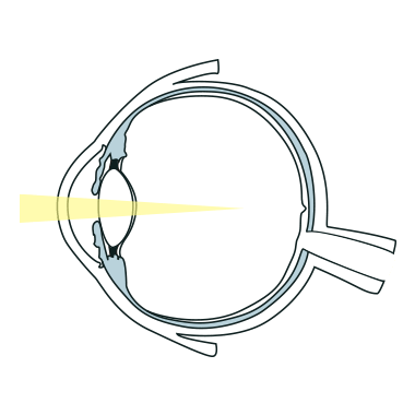 レーザー治療イラスト