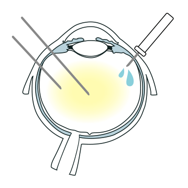 硝子体手術イラスト